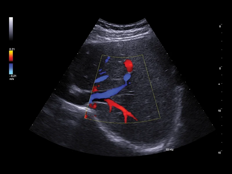 MyLab™A50 - Color Doppler (CFM), liver