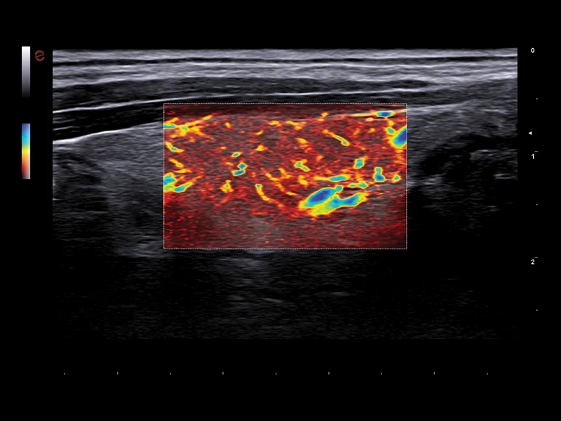 MyLab™A50 - microV microvascular imaging