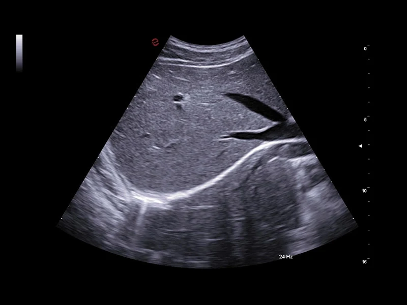 MyLab™A50 - B-Mode, liver