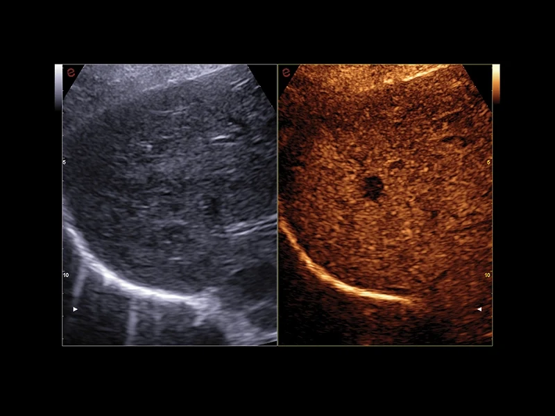 MyLab™A50 - CnTI contrast imaging, liver