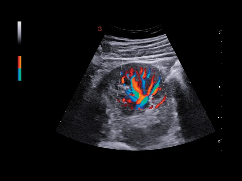 MyLab™A50 - pulsed-wave Doppler (PW), kidney