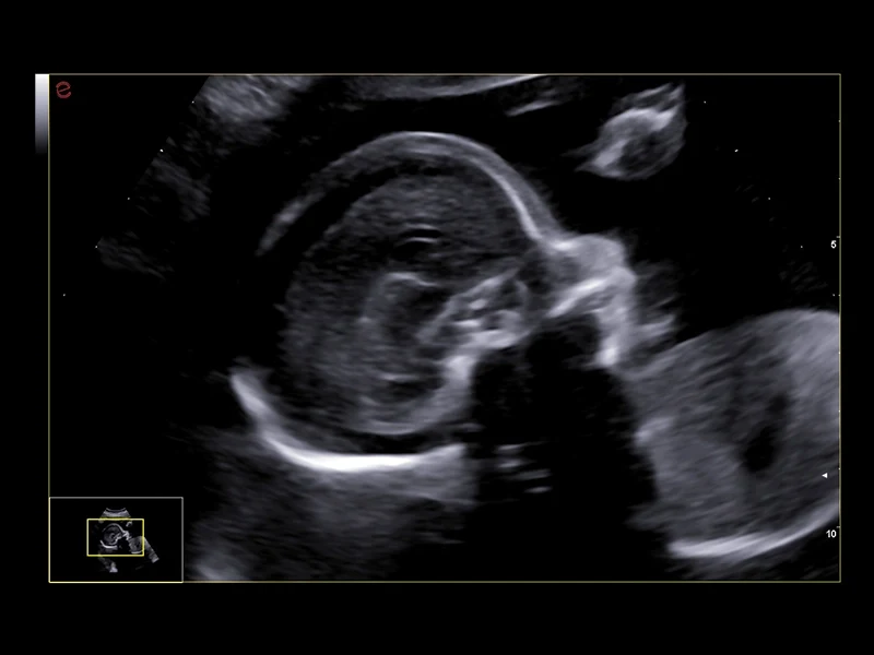 MyLab™A50 - fetal face profile
