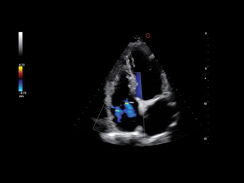 MyLab™A50 - Color Doppler (CFM), heart