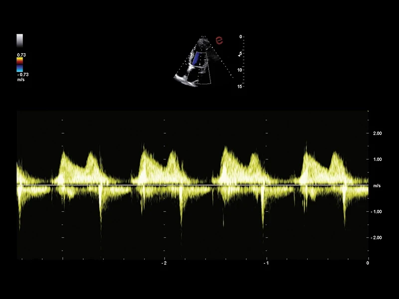 MyLab™A50 - continuous-wave Doppler (CW), heart