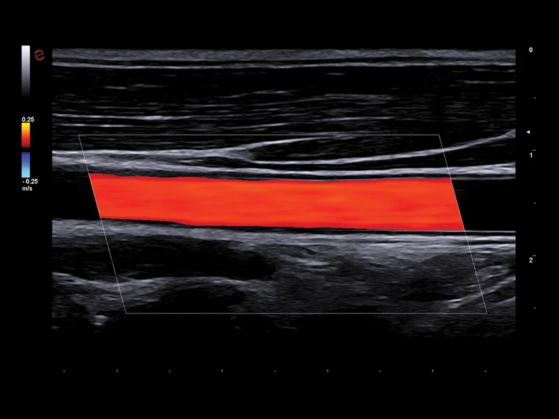 MyLab™A50 - Color Doppler (CFM), vascular