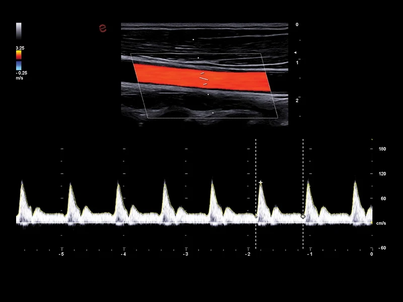 MyLab™A50 - pulsed-wave Doppler (PW), vascular