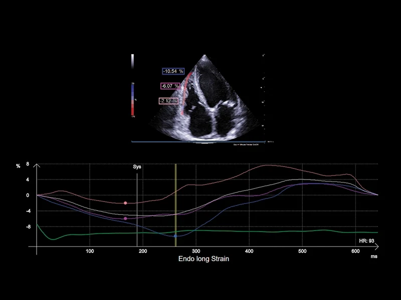 MyLab™A70 - XStrain, right ventricle