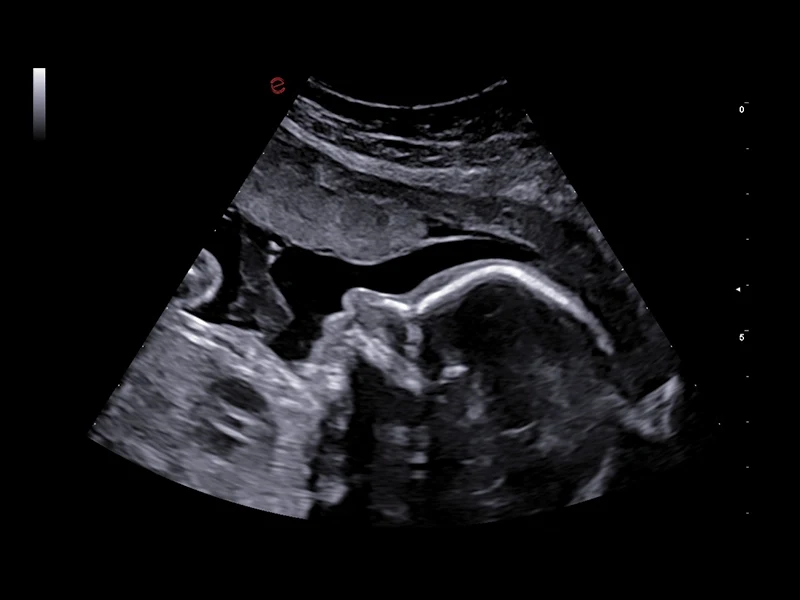 MyLab™A70 - fetal face