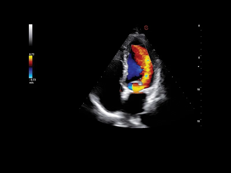 MyLab™A70 - Color Doppler (CFM), heart