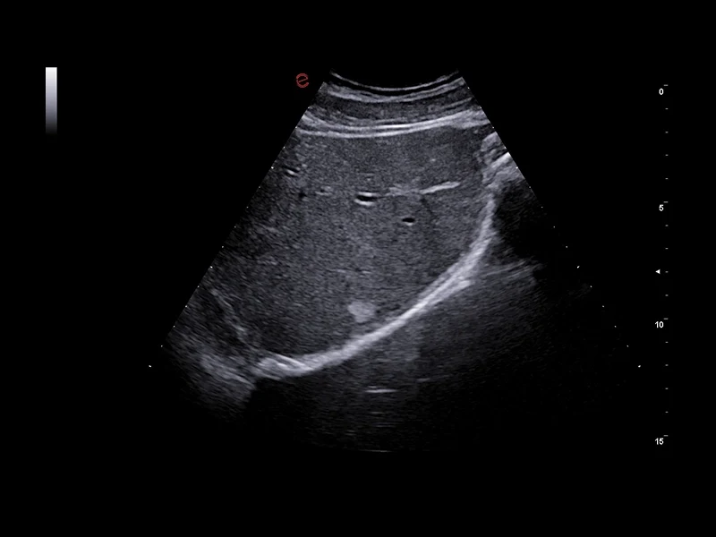 MyLab™A70 - B-Mode, liver
