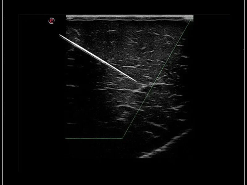 MyLab™Omega - wizualizacja końcówki igły (Needle Enhancement)