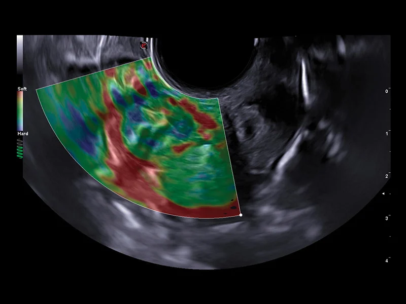 Gynaecology clinical image