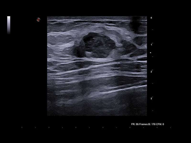 Breast clinical image