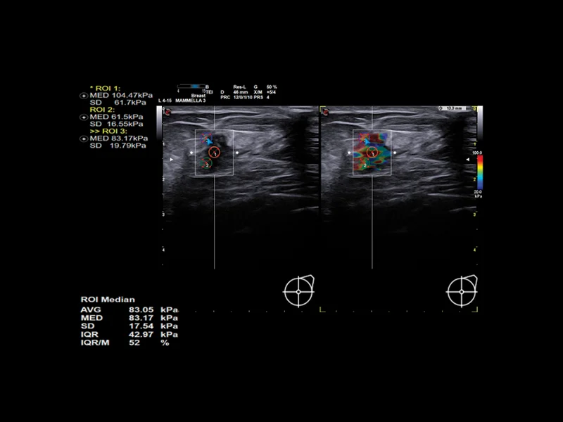 Breast clinical image