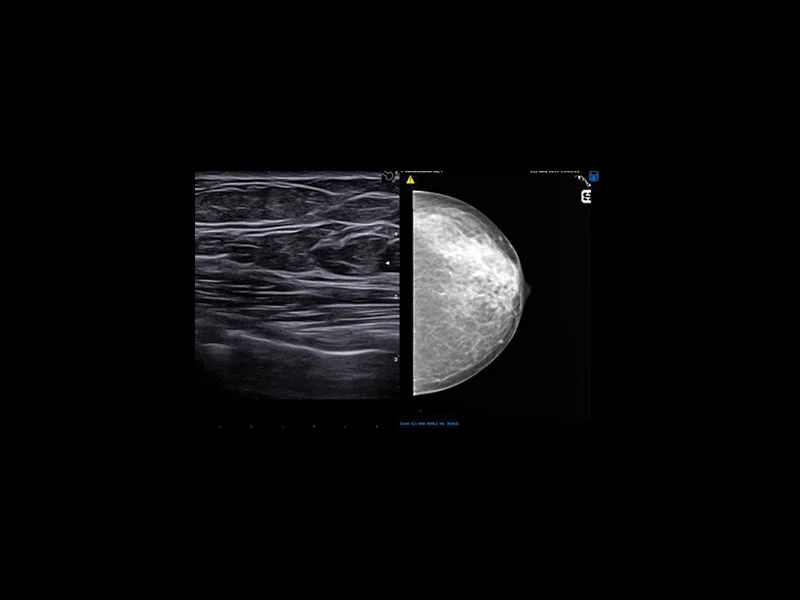 Breast clinical image